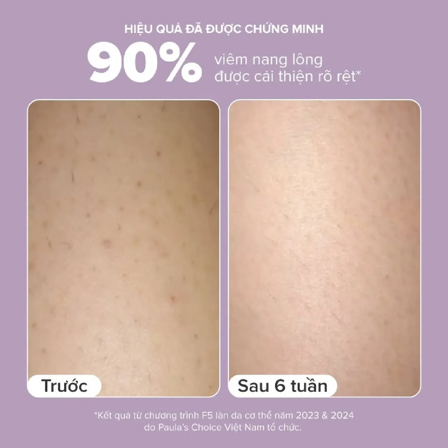 kem-duong-the-paulas-choice-bha-body-smoothing-spot-11