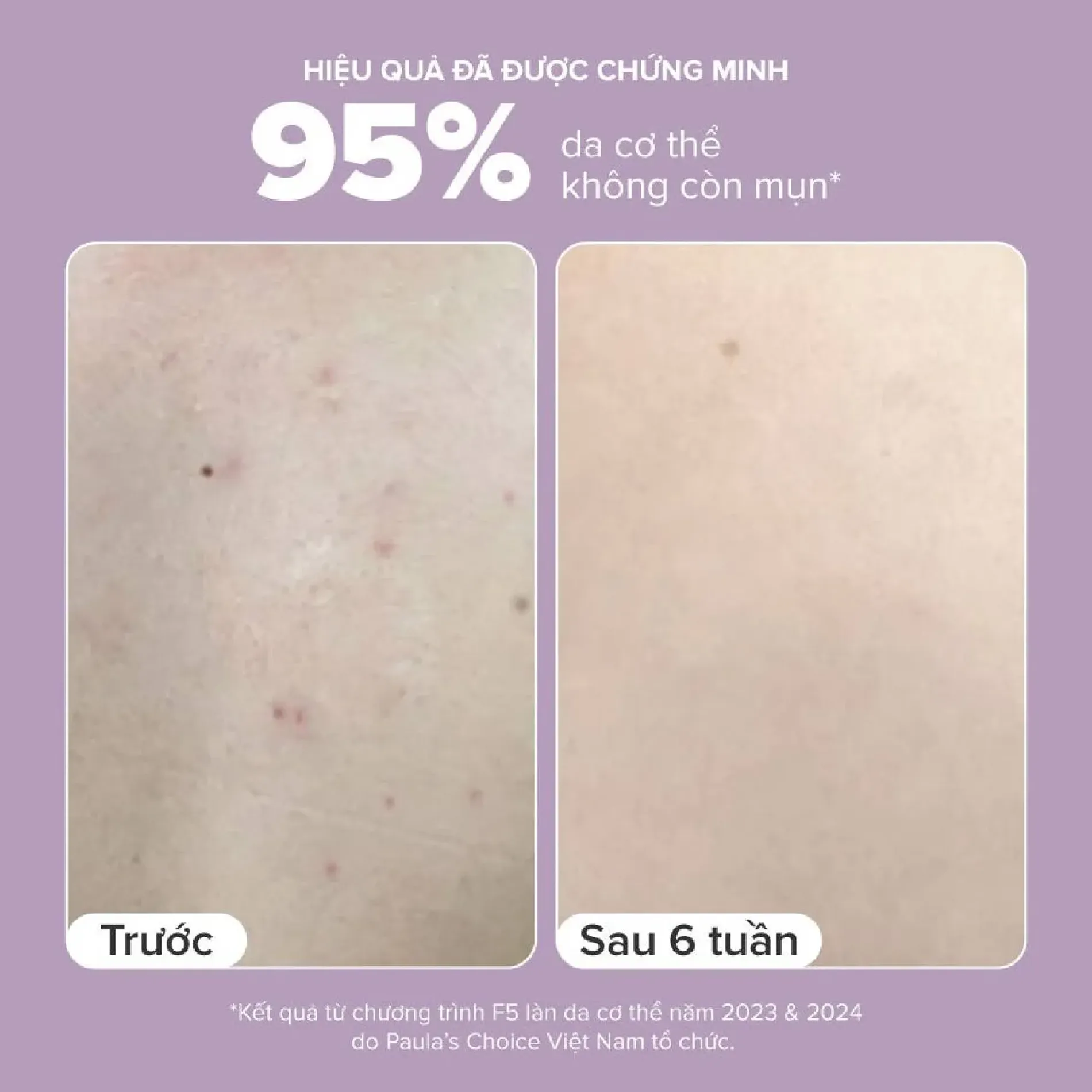 kem-duong-the-paulas-choice-bha-body-smoothing-spot-10