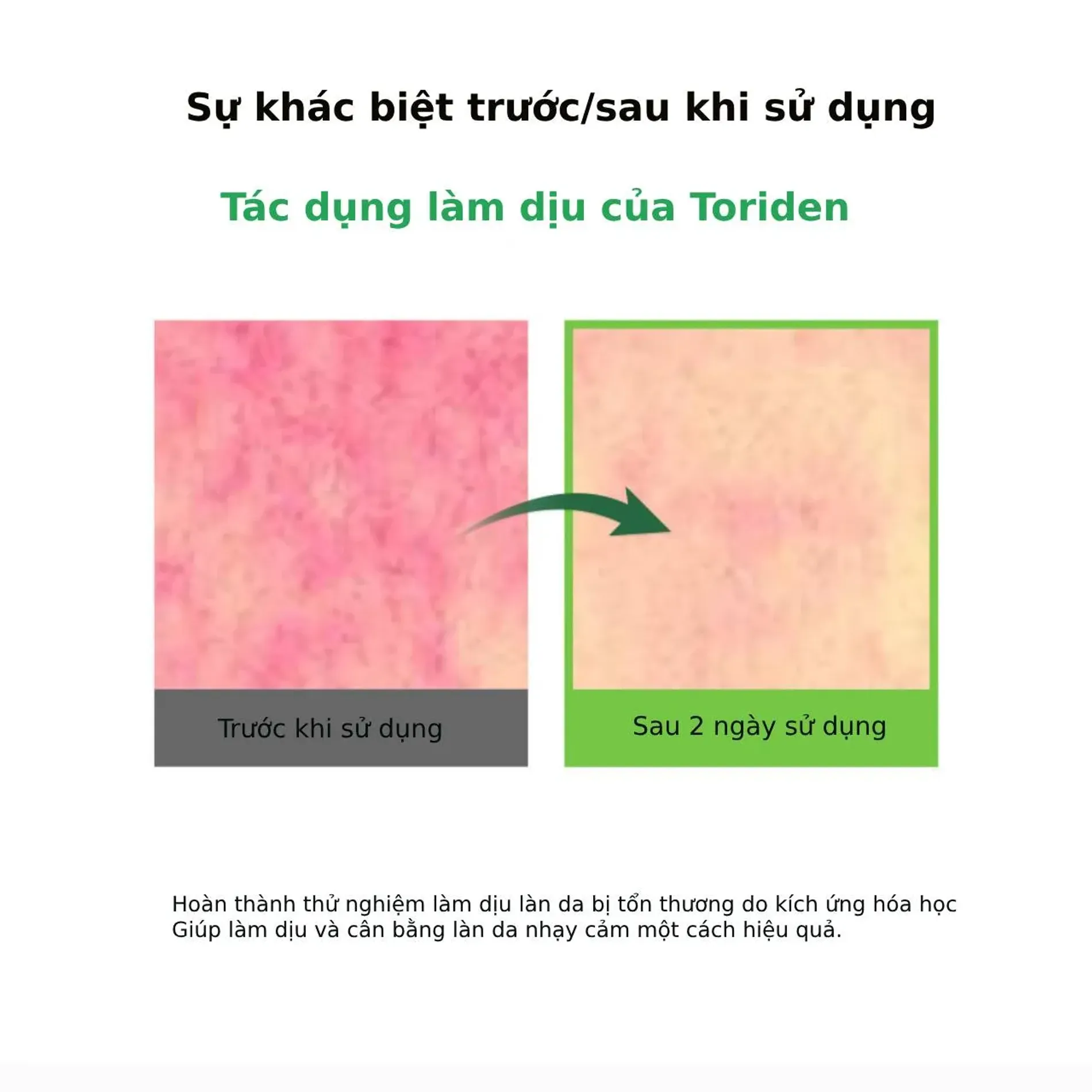 tinh-chat-torriden-lam-diu-giam-man-do-cho-da-mun-balanceful-cica-serum-50ml-11