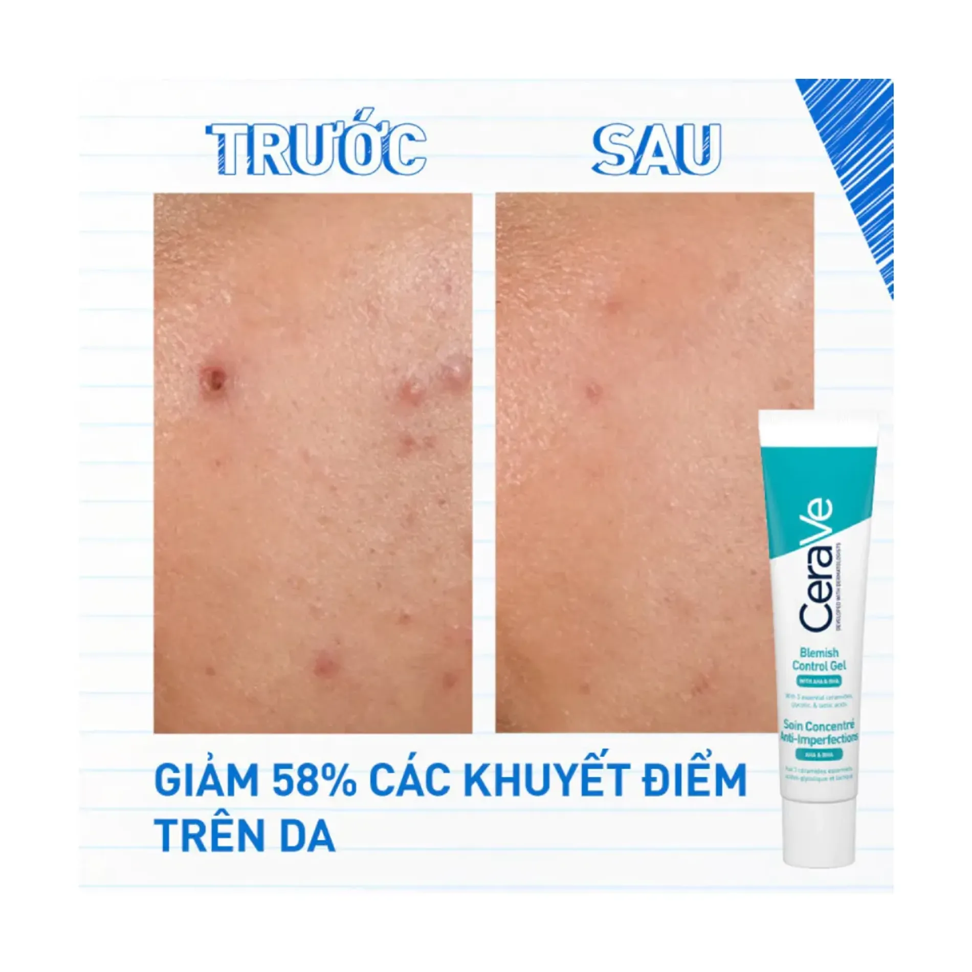 gel-giam-mun-va-tham-mun-cerave-acne-blemish-control-gel-40ml-5