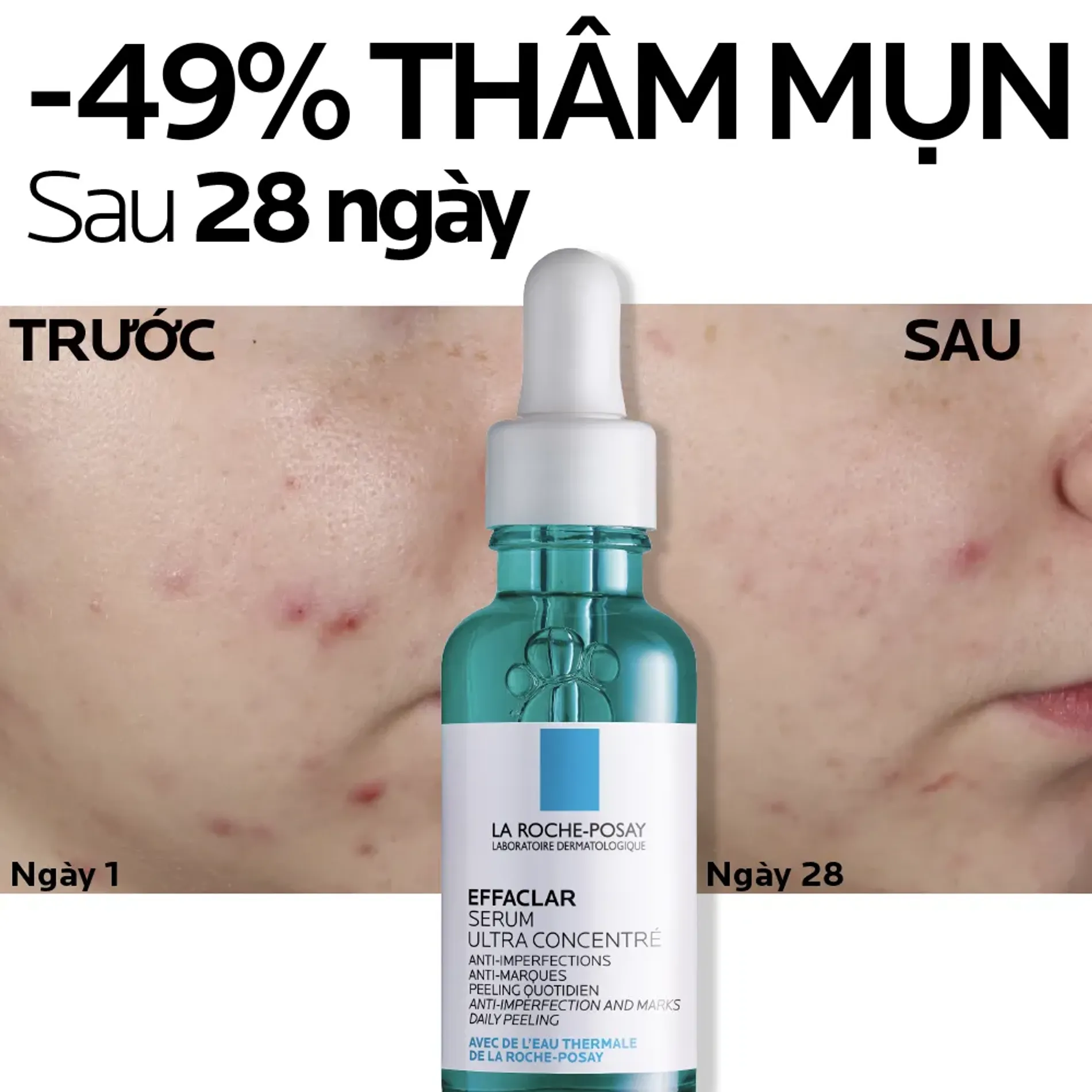 tinh-chat-giam-mun-giam-tham-thu-nho-lo-chan-la-roche-posay-effaclar-ultra-concentrated-serum-30ml-7