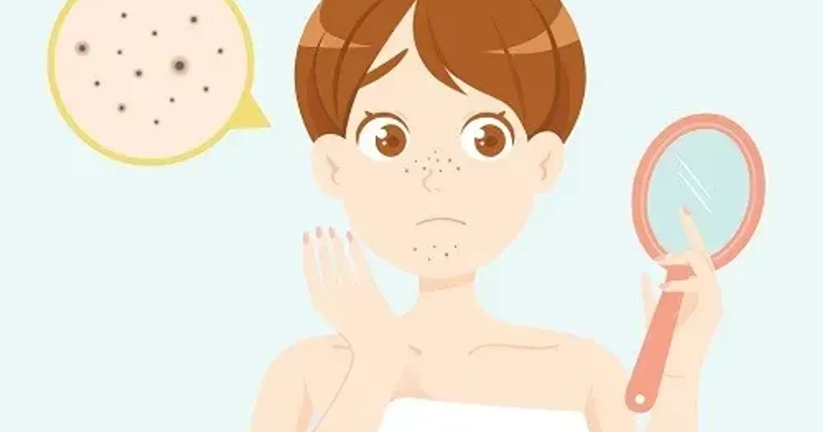 10 công thức mặt nạ DIY giúp loại bỏ mụn đầu đen - The Face Shop Chính Hãng