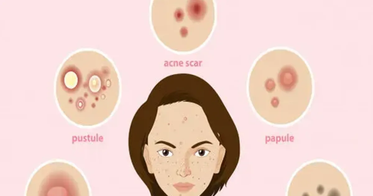 Mụn trứng cá là gì? Cơ chế hình thành, Nguyên nhân và Cách điều trị - The Face Shop Chính Hãng