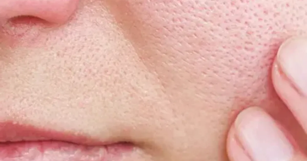 Nguyên nhân và cách điều trị lỗ chân lông to - The Face Shop Chính Hãng
