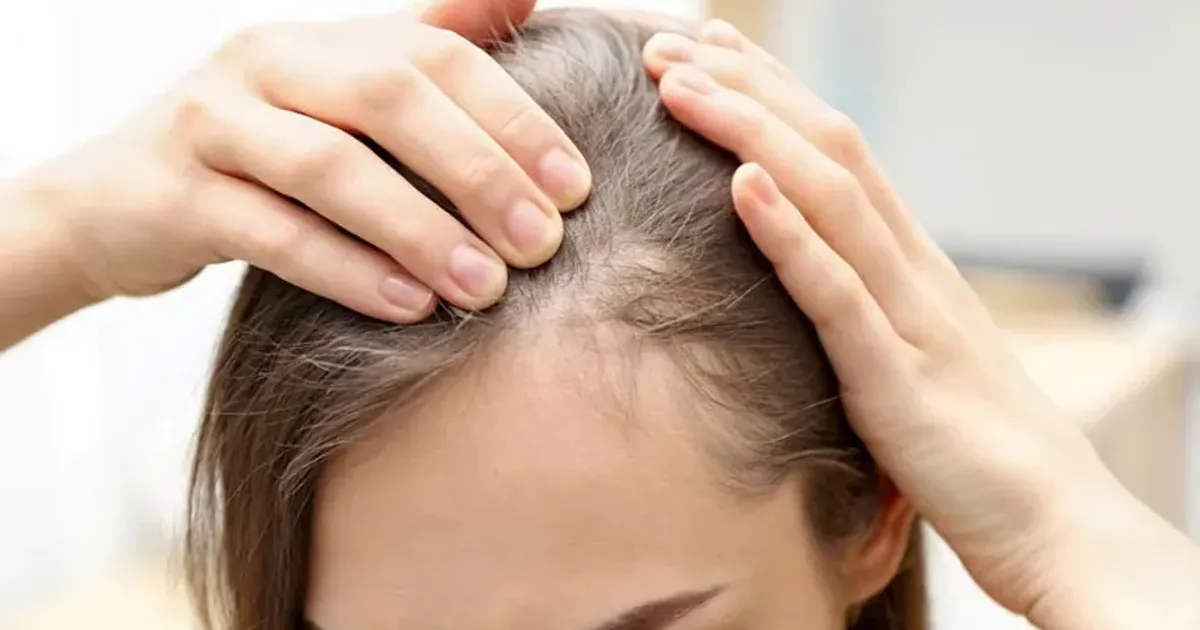 Nguyên nhân và cách khắc phục tóc hói, tóc thưa hiệu quả - The Face Shop Chính Hãng