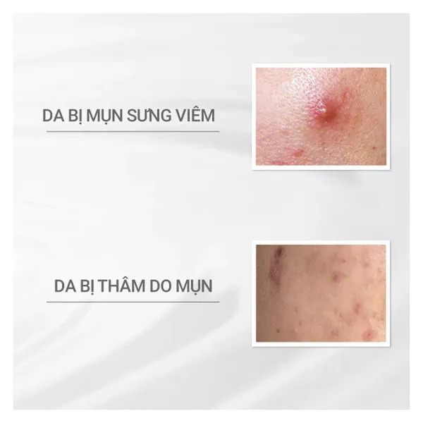 tinh-chat-dprogram-giam-mun-mo-vet-tham-acne-care-spot-essence-15g-5