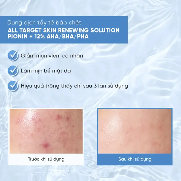 dung-dich-tay-te-bao-chet-emmie-all-target-skin-renewing-solution-120ml-5