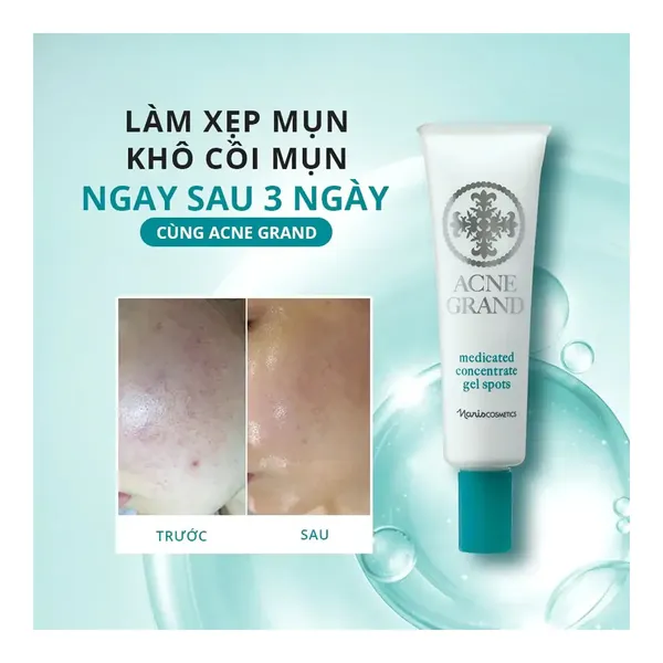 gel-cham-mun-naris-acne-grand-medicated-concentrate-gel-spots-20g-3